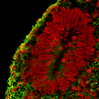 Cerebellar organoid PCH patient